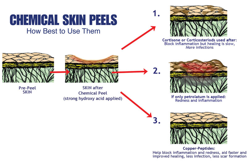 Chemical Skin Peels